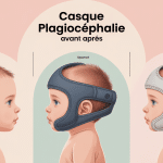 casque plagiocéphalie avant après illustration évolution crâne